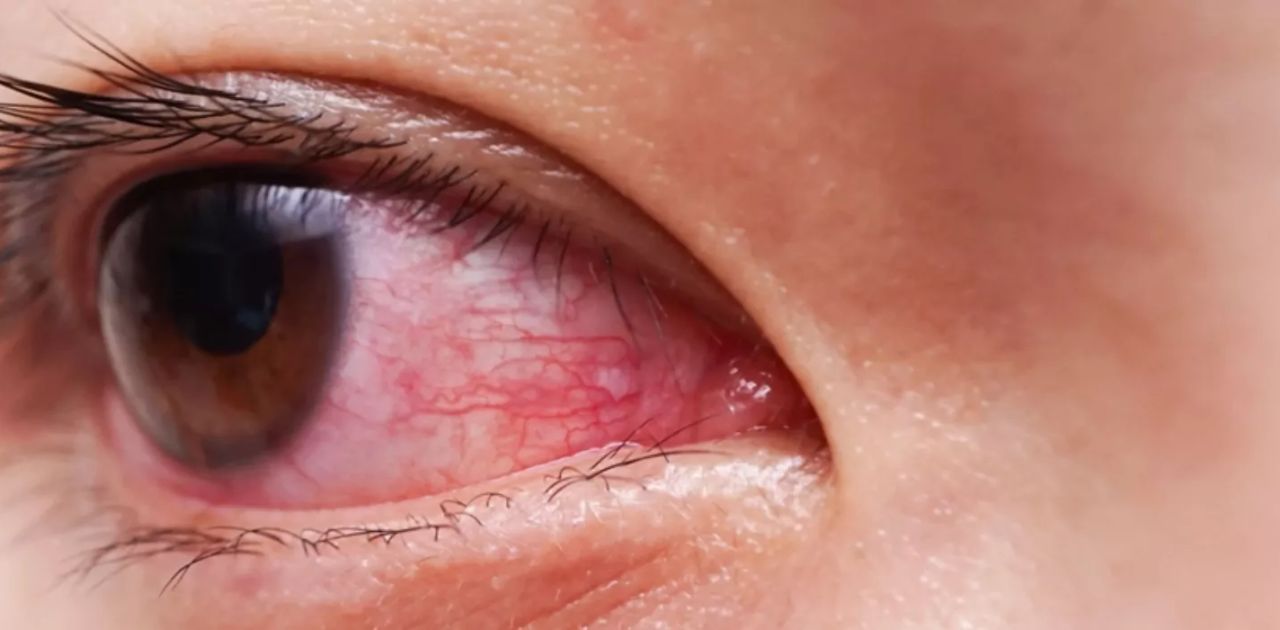 Bloodshot Eyes: What to Do, When to Worry