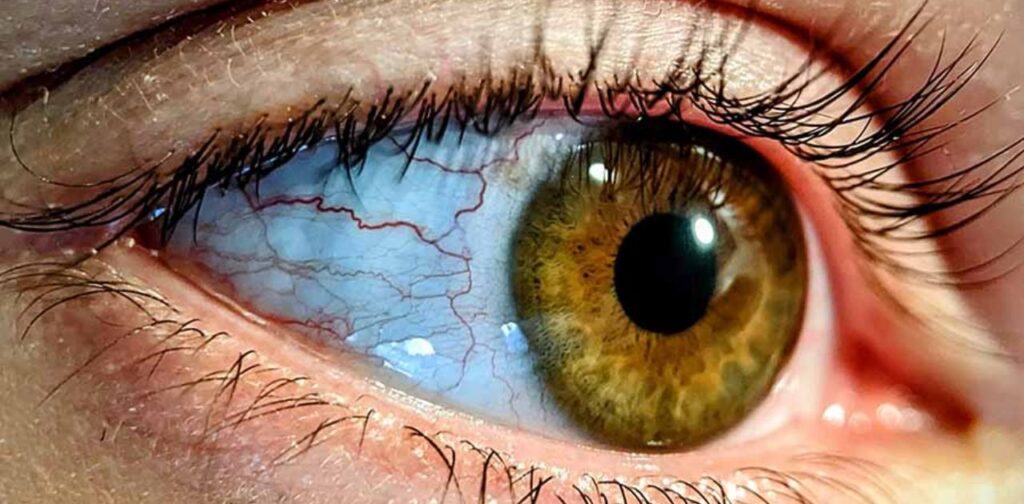 Red Flags: When Should You Be Concerned About Bloodshot Eyes?